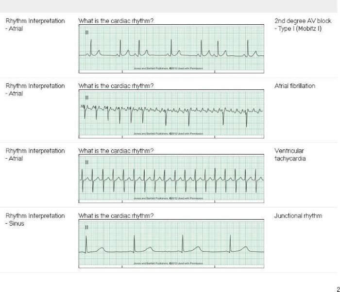 Prophecy dysrhythmia basic a test answers