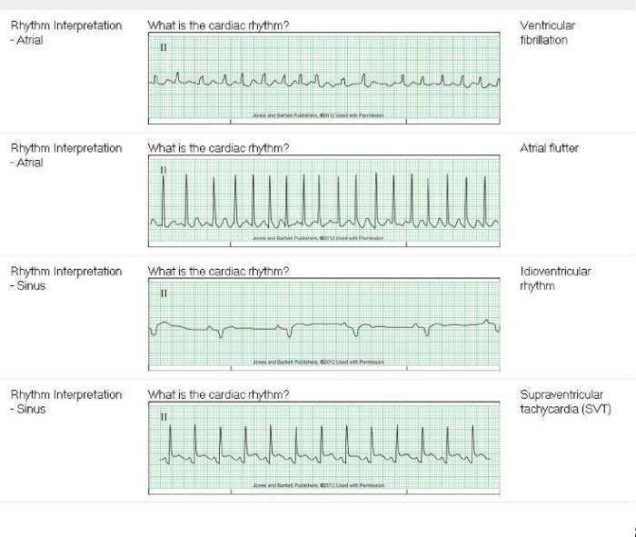 Prophecy dysrhythmia basic a test answers