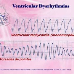 Prophecy dysrhythmia basic a test answers