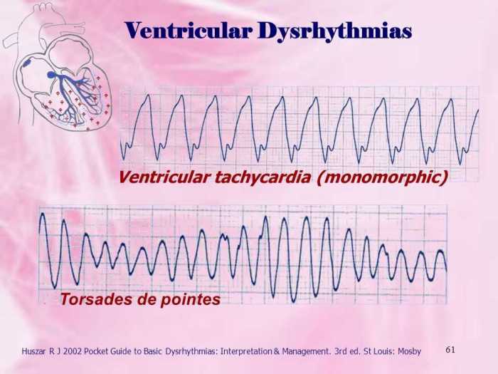 Prophecy dysrhythmia basic a test answers